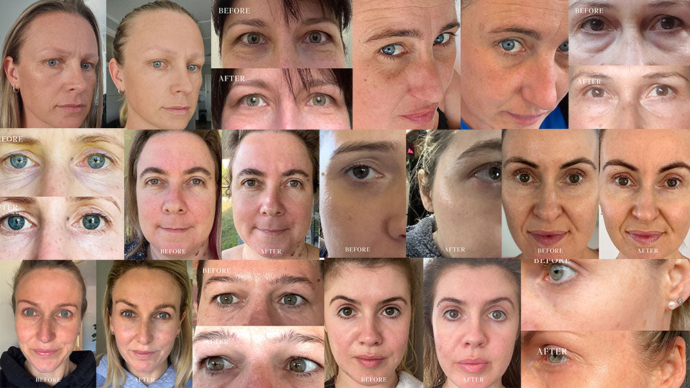 Bye-Bye, Botox
